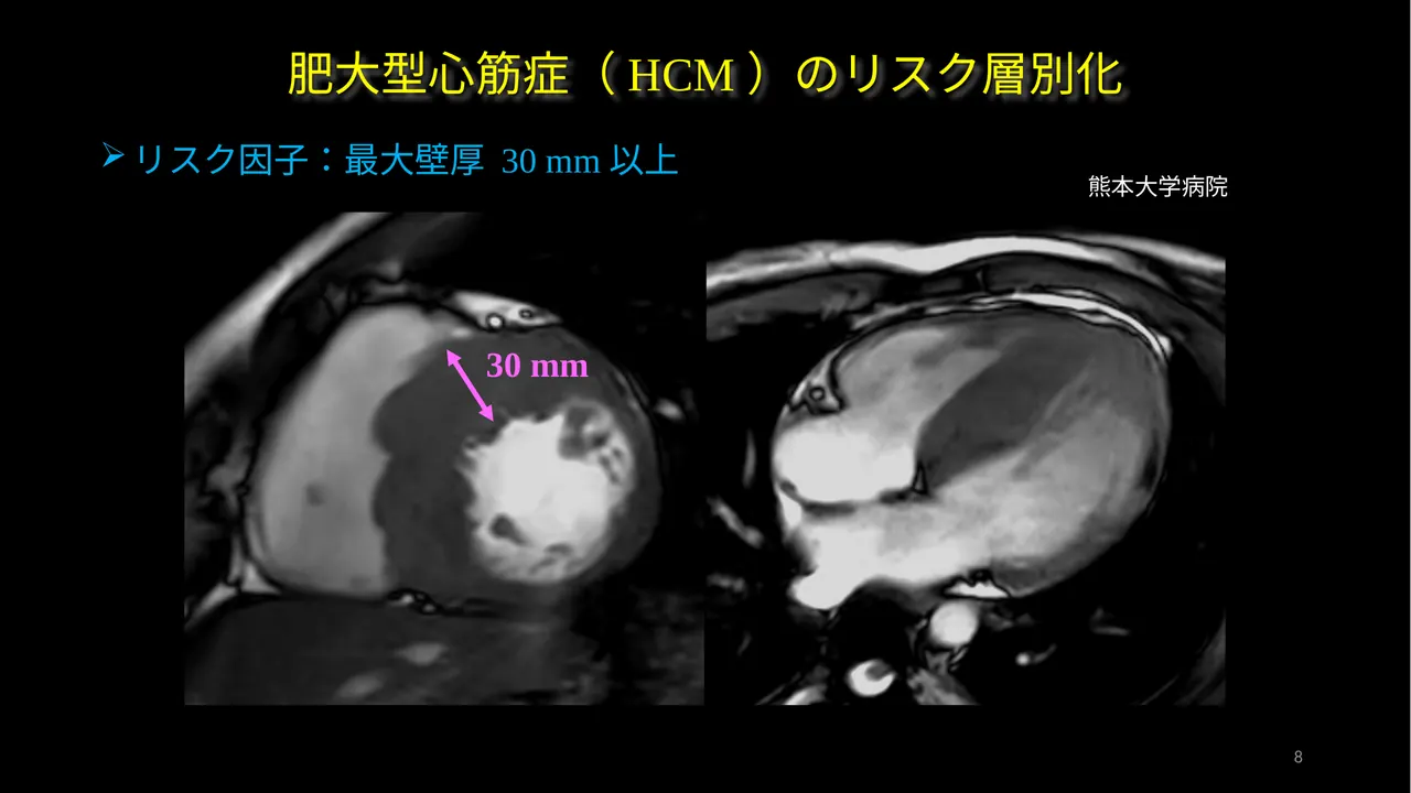 HCM max wall thickness