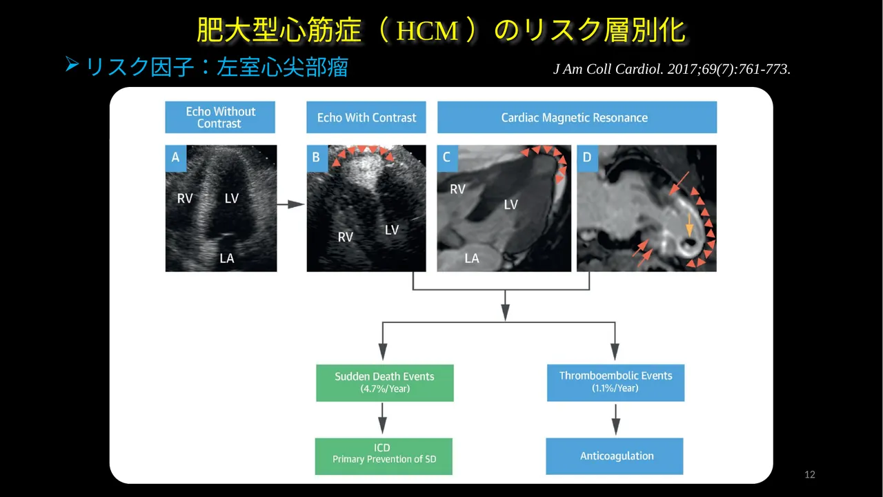 HCM apical aneurysm slide