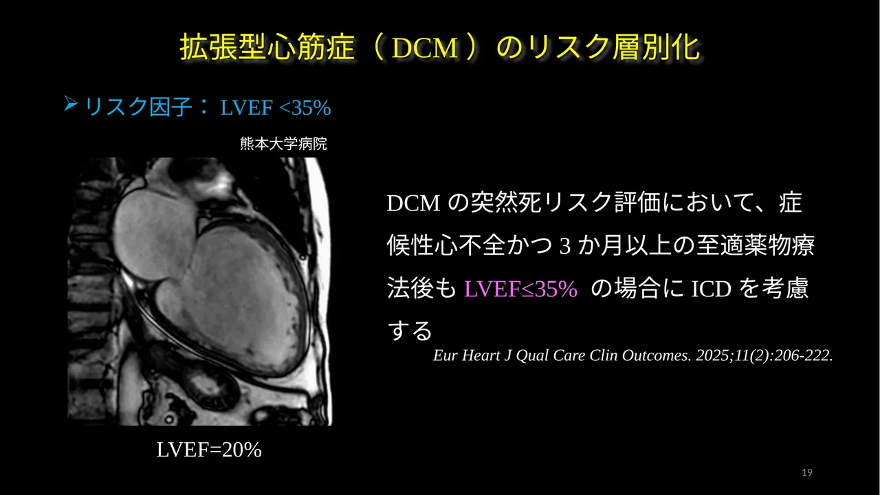 DCM EF less than 35