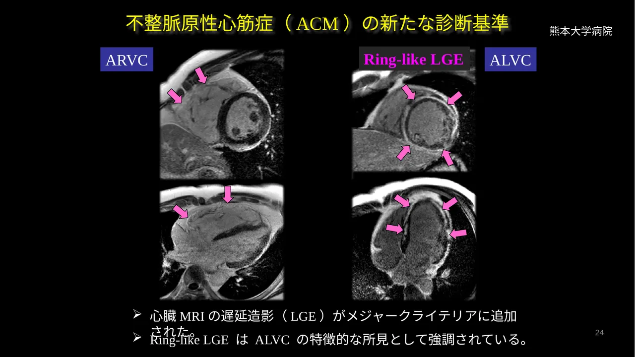 ACM Padua criteria and ring-like LGE