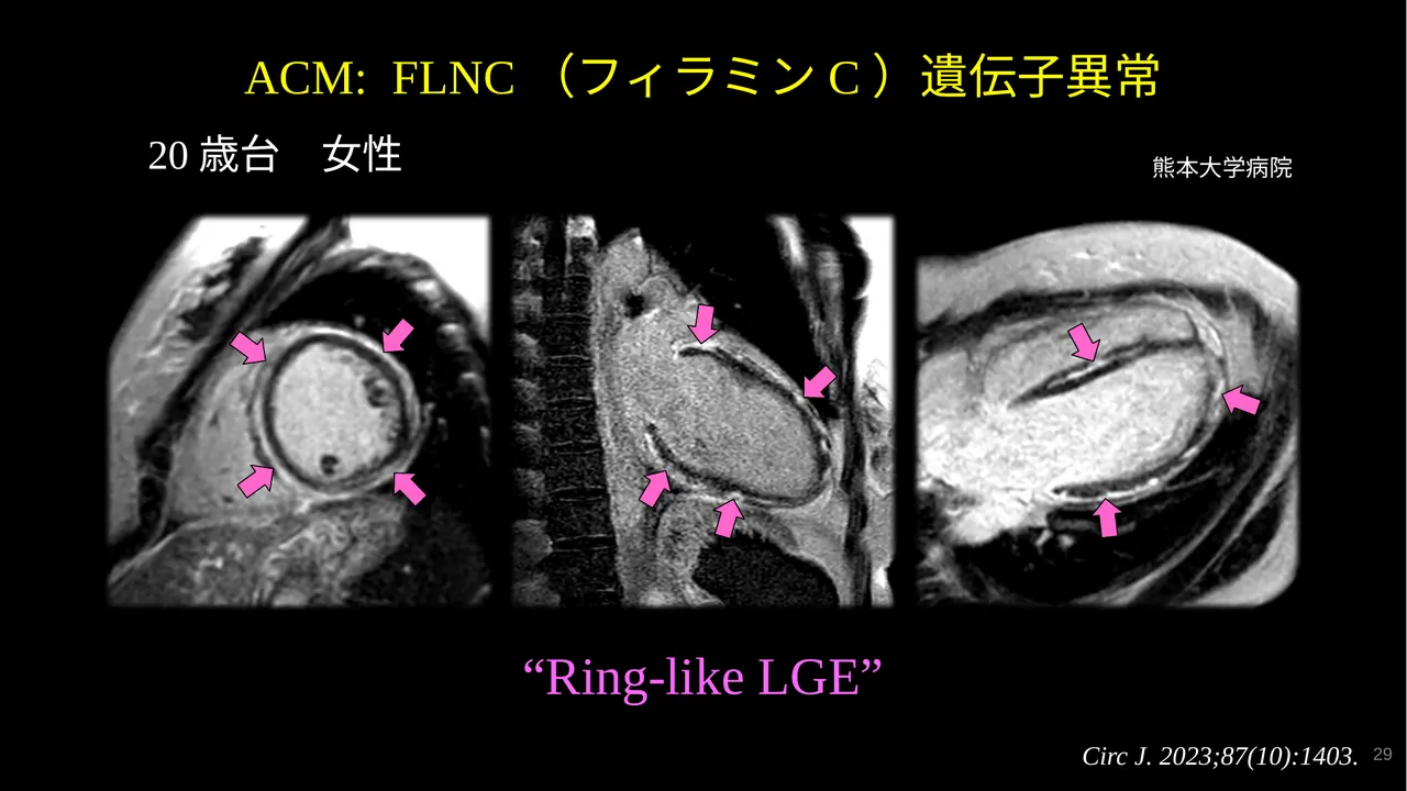 FLNC ACM ring-like LGE