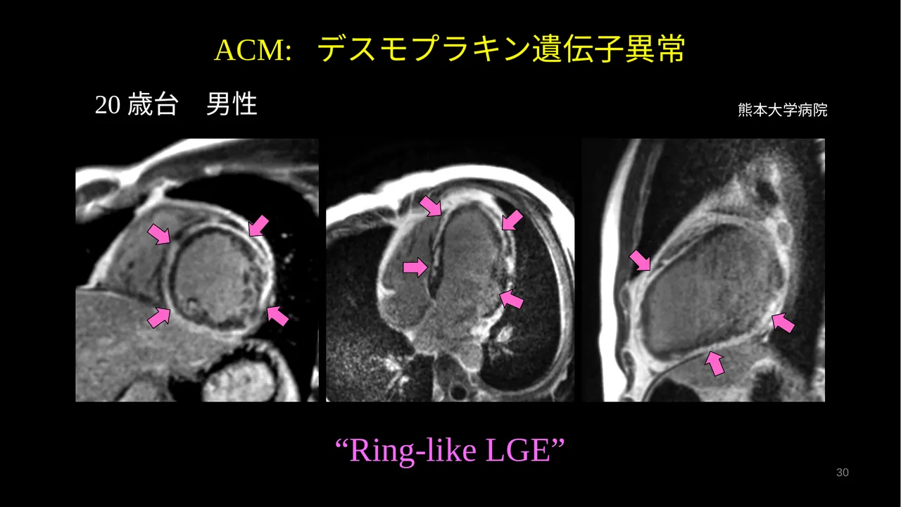 DSP ACM ring-like LGE