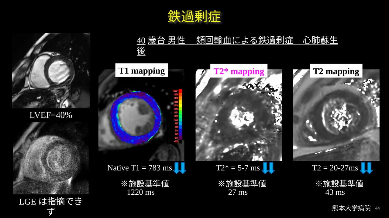 Iron overload case